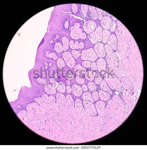 Tongue Mandible Cancer Oral Cancer Invasive Stock Photo 2092774129 ...