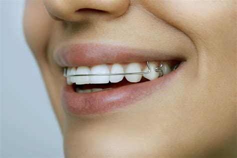 Beltway Orthodontics Removable Metal Retainers In Atlanta