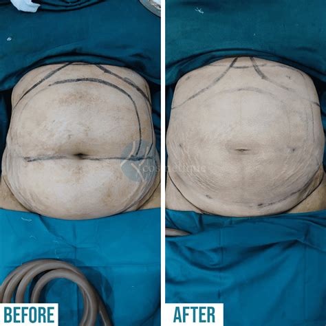 Before & After - We Are Best For Liposuction