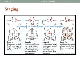 Burkitt lymphoma | PPT