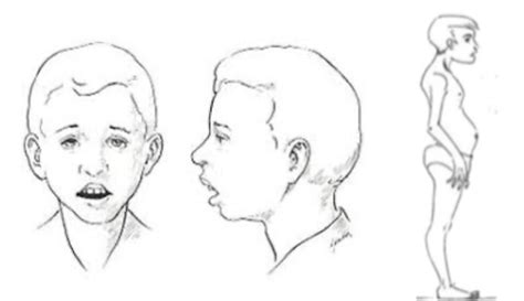 La Respiraci N Bucal Cambia Las Facciones De Tu Hijo