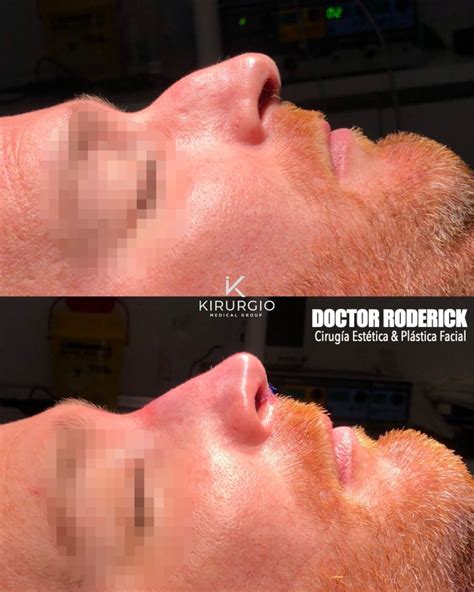 Rinoplastia Barcelona Kirurgio Medical Center