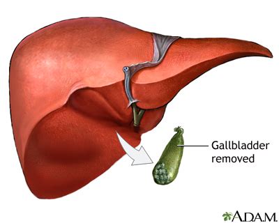 Gallbladder Removal