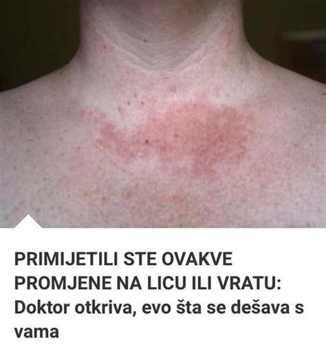 PRIMIJETILI STE 0VAKVE PROMJENE NA LICU ILI VRATU Doktor Otkriva Evo