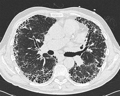 Idiopathic Pulmonary Fibrosis