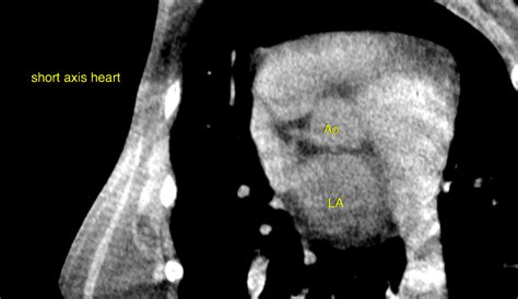 Ct Disseminated Cylindrical Peripheral Bronchiectasis Without