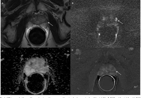 Figure From Multiparametric Magnetic Resonance Imaging Vs Standard