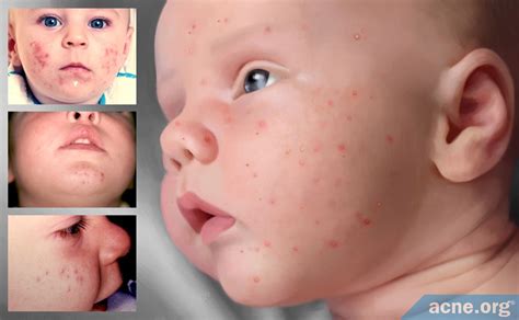 Causes And Treatments For Baby Acne