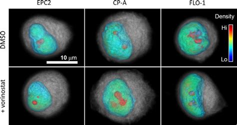 Treatment With Vorinostat Preferentially Decreases The Nuclear Size And