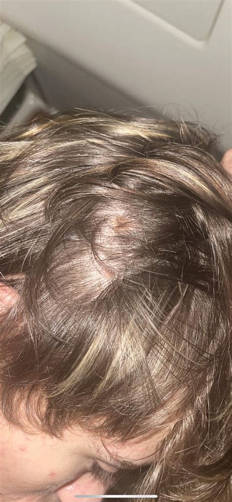 Moles On Scalp R Dermatology