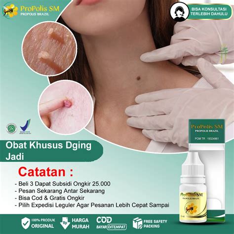 Jual Obat Daging Jadi Kutil Kelamin Skin Tag Papiloma Keloid Milia