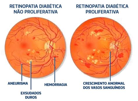 Retinopatia Diab Tica Dr Ergo