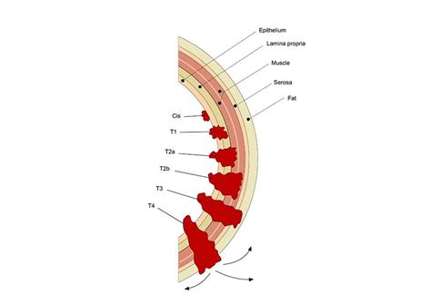 Prostate Cancer Treatment- Causes, Symptoms, Screening, Diagnosis, Stages