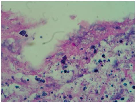 Sporothrix Schenckii Histology