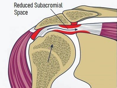 Dealing With Acromion Pain With The Best Exercises For Relief ...