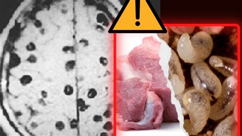 Cómo saber si tengo cisticercosis en el cerebro Su Médico