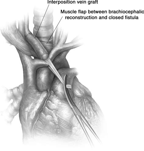 Technique For Managing Tracheo Innominate Artery Fistula Operative