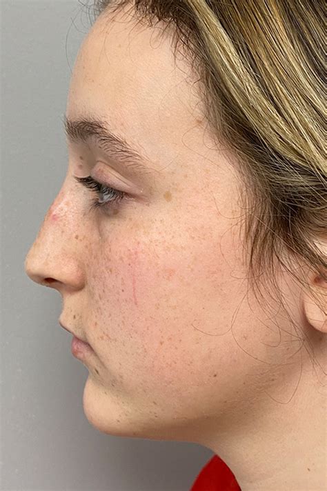 Los Angeles Rhinoplasty Before After Photos Patient 14 Dr Aminpour