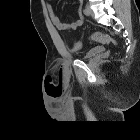 Indirect Inguinal Hernia Image