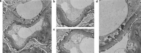 Podocyte Foot Process Effacement As A Diagnostic Tool In Focal