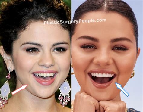 Selena Gomez Teeth Fix