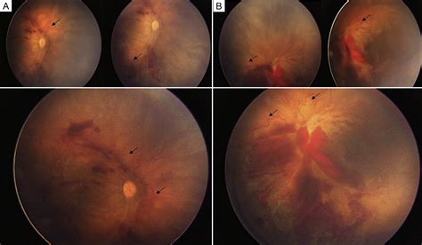 A Rare Case Of Aggressive Posterior Retinopathy Of Prematurity