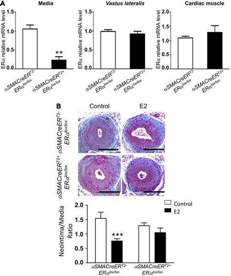 17β Estradiol E2 decreases intimal hyperplasia through its specific