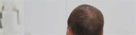 Androgenetic Alopecia Or Pattern Baldness Symptoms Causes Risk