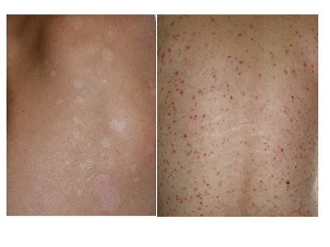 Malassezia Yeasts—everywhere And Sometimes Dangerous