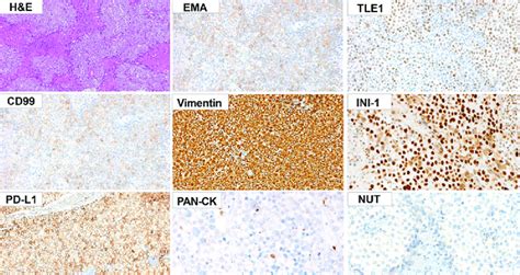 Microscopic Findings Of Smarca4 Deficient Thoracic Sarcoma Download Scientific Diagram