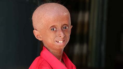 Fajarv: Progeria Rare Genetic Disorder