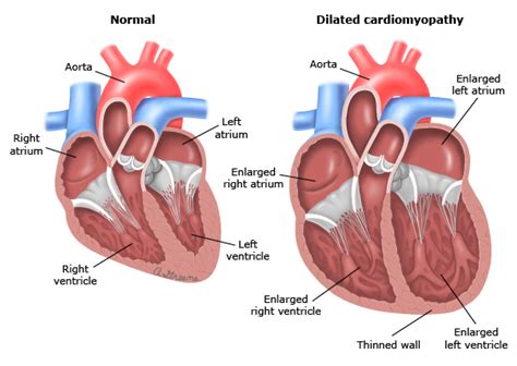 Dilated Cardiomyopathy Cardiovascular Medbullets Step 23