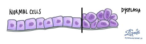 What does dysplasia mean? - Pathology dictionary - MyPathologyReport