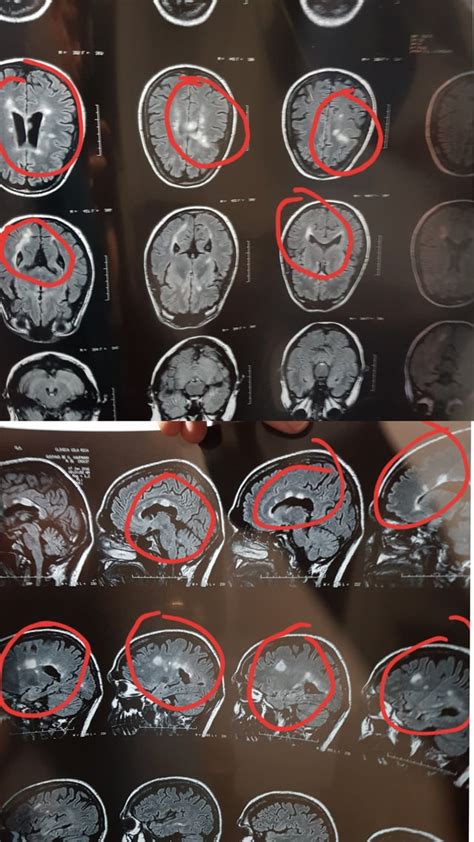 What Multiple Sclerosis brain lesions look like in a MRI. These were ...