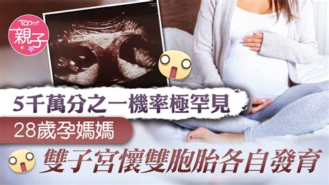 【雙子宮懷孕】5千萬分之一機率極罕見 28歲媽媽雙子宮懷雙胞胎各自發育