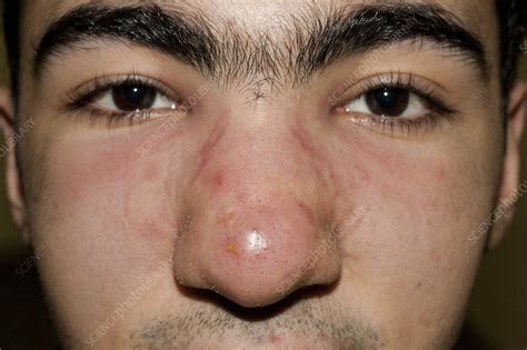 Acne Cyst On Nose