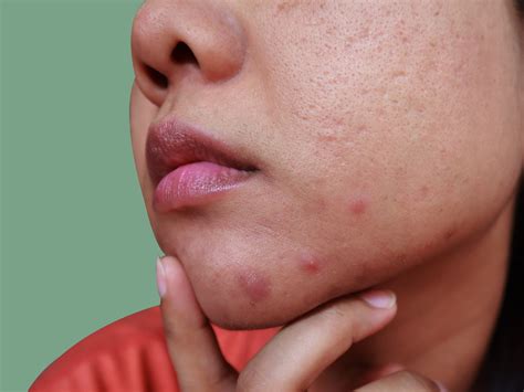 What Causes Chin Acne And How To Treat It According To Dermatologists Self