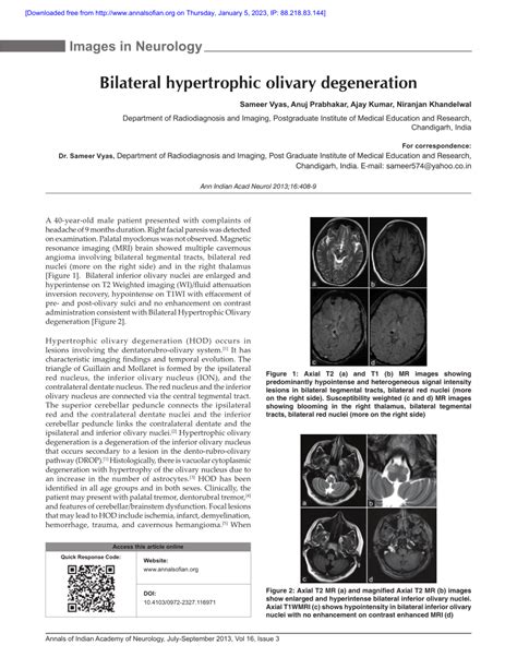 Pdf Bilateral Hypertrophic Olivary Degeneration