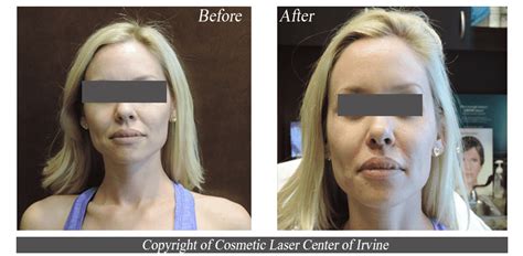 Before & After - Irvine, CA: Cosmetic Laser Center of Irvine