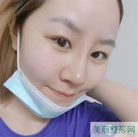 云大医院整形科隆鼻吗？价格表隆鼻案例反馈~美嘉整形网美学知识