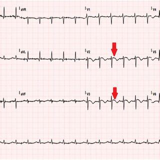 A 12lead Electrocardiogram Showing Sinus Tachycardia With Anterior