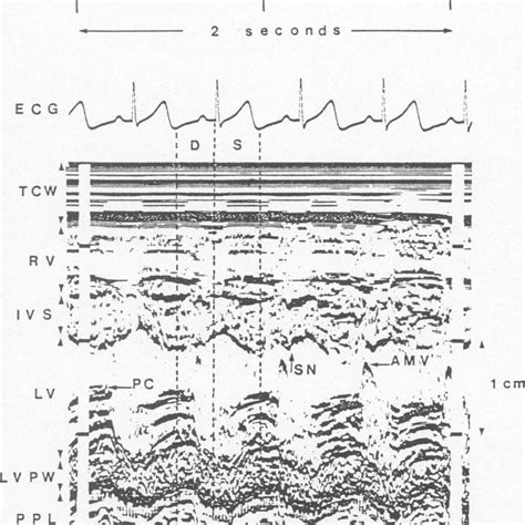 Measurements of the left ventricular dimension at end diastole (LVDd ...