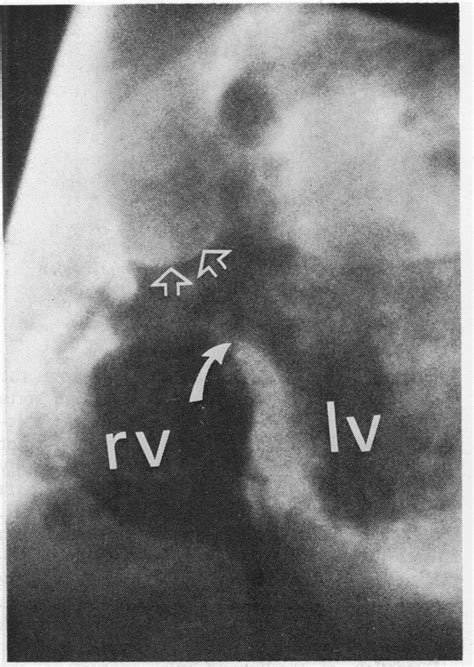 Tetralogy Left Anterior Oblique The Interventricular Septum Is Download Scientific Diagram