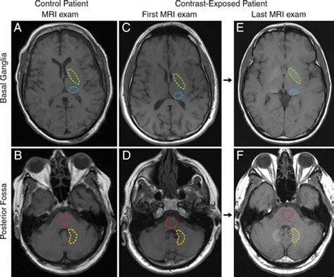 Intracranial Gadolinium Deposition After Contrast Enhanced MR Imaging