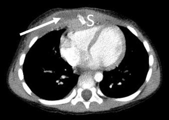 Sternal Fracture Complicated By A Subcutaneous Abscess In A 5 Year Old