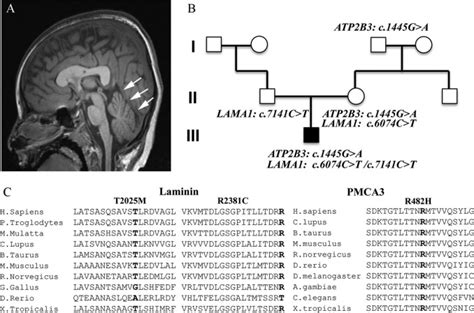 A Novel Mutation In Isoform 3 Of The Plasma Membrane Ca2 Pump Impairs