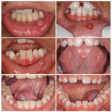 Mucocele Floor Of Mouth