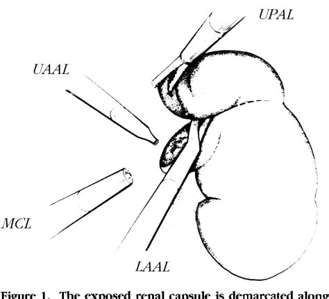 Figure 1 From Laparoscopic Wedge Resection And Partial Nephrectomy