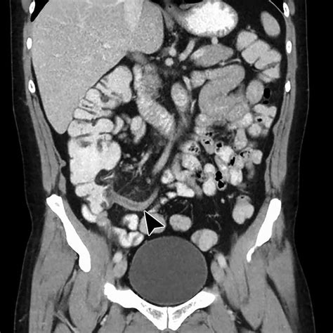 Positive Oral Contrast Material For Abdominal Ct Current Clinical Indications And Areas Of