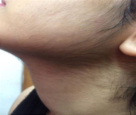 Figure 3 From Krukenberg Tumor Manifesting With Hirsutism And